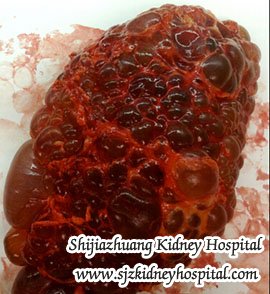 Polycystic Kidney Disease and Edema Herbal Treatment in China