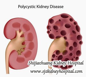 Natural Treatment for Polycystic Kidney Disease with Small Cysts