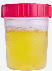 Does Protein in Urine Means the Kidneys are Starting to Fail