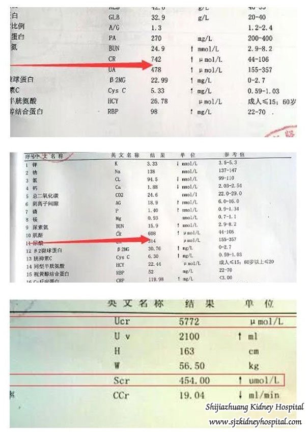Kidney Failure Patient with Creatinine 758 Has Get Rid of Dialysis