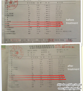 After 12 Years of Transplant the Creatinine Level Increased to 1054