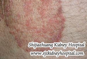 Can PKD Cause Itching Skin