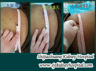 Can Back Pain and Bloated Abdomen be Remitted for PKD Patients