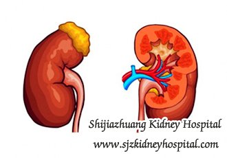 The Helpful Tips for Patients with PKD