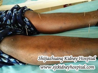 How to Cast Off Edema for Chronic Nephritis Patients