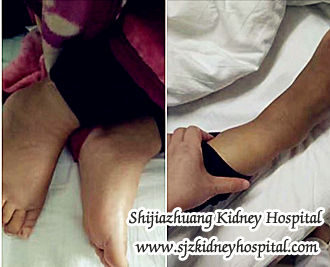 Can Kidney Problem Leads to Swollen Legs