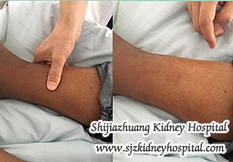 Would I Get Rid of Edema on Both Two Legs Without Dialysis