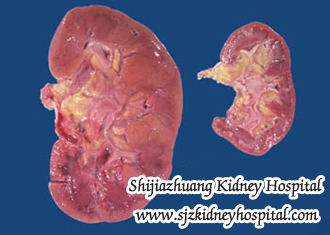 What Can I Do If My Kidneys are Shrink
