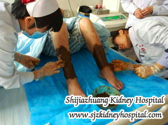 Could You Tell Me What Are These Chinese Herbal Treatments to CKD