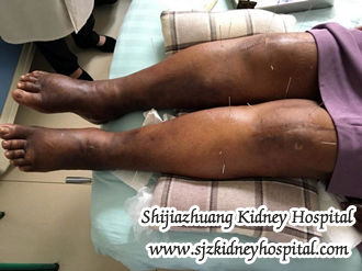 How Would I Cure Swollen Foot In Nephrotic Syndrome with Creatinine 349